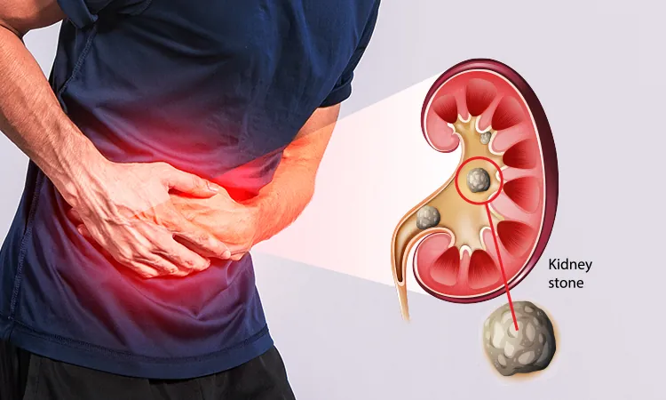 Kidney stone disease