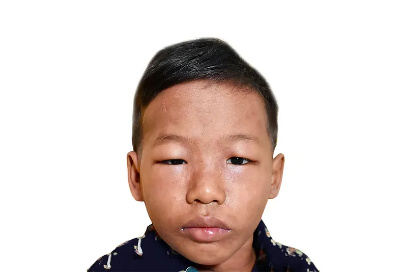 Nephrotic syndrome care
