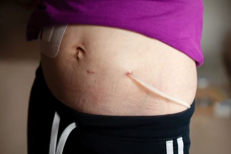 Peritoneal dialysis CAPD